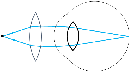 correcting farsightedness