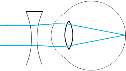 correcting nearsightedness